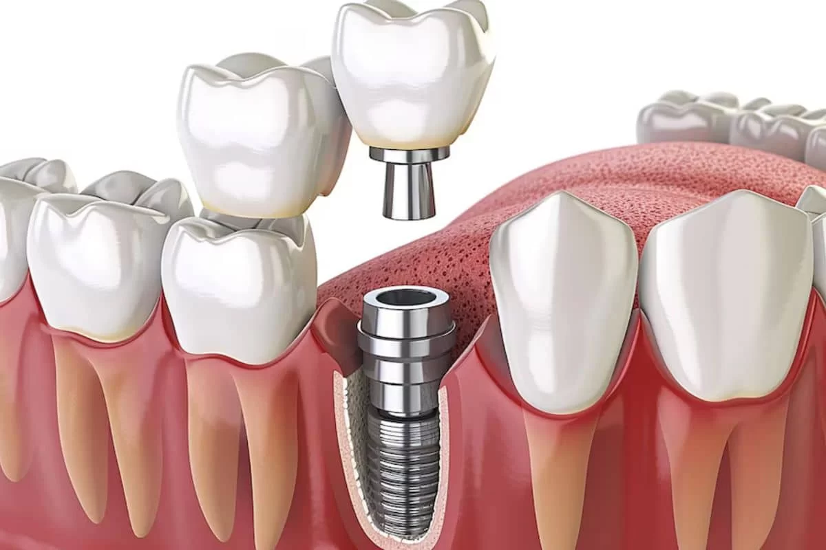 Best Practices for Maintaining Your Dental Implants: Essential Tips for Longevity and Care
