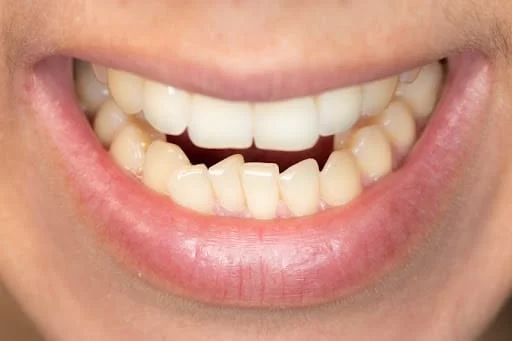 How to Stop Teeth from Shifting After Braces: Effective Tips and Retainer Use