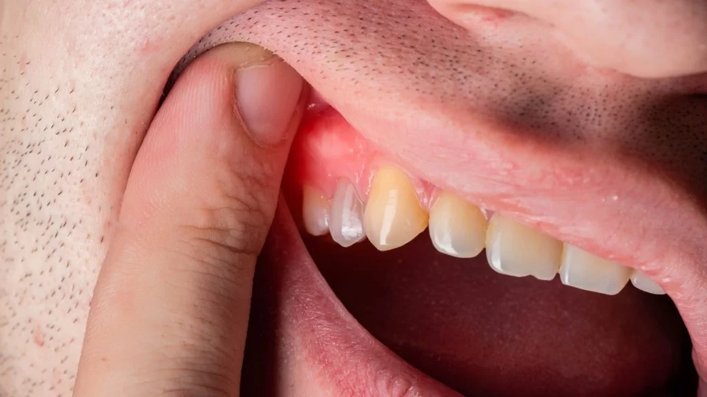 How to Treat Gum Pain Caused by Dentures: Effective Relief and Remedies