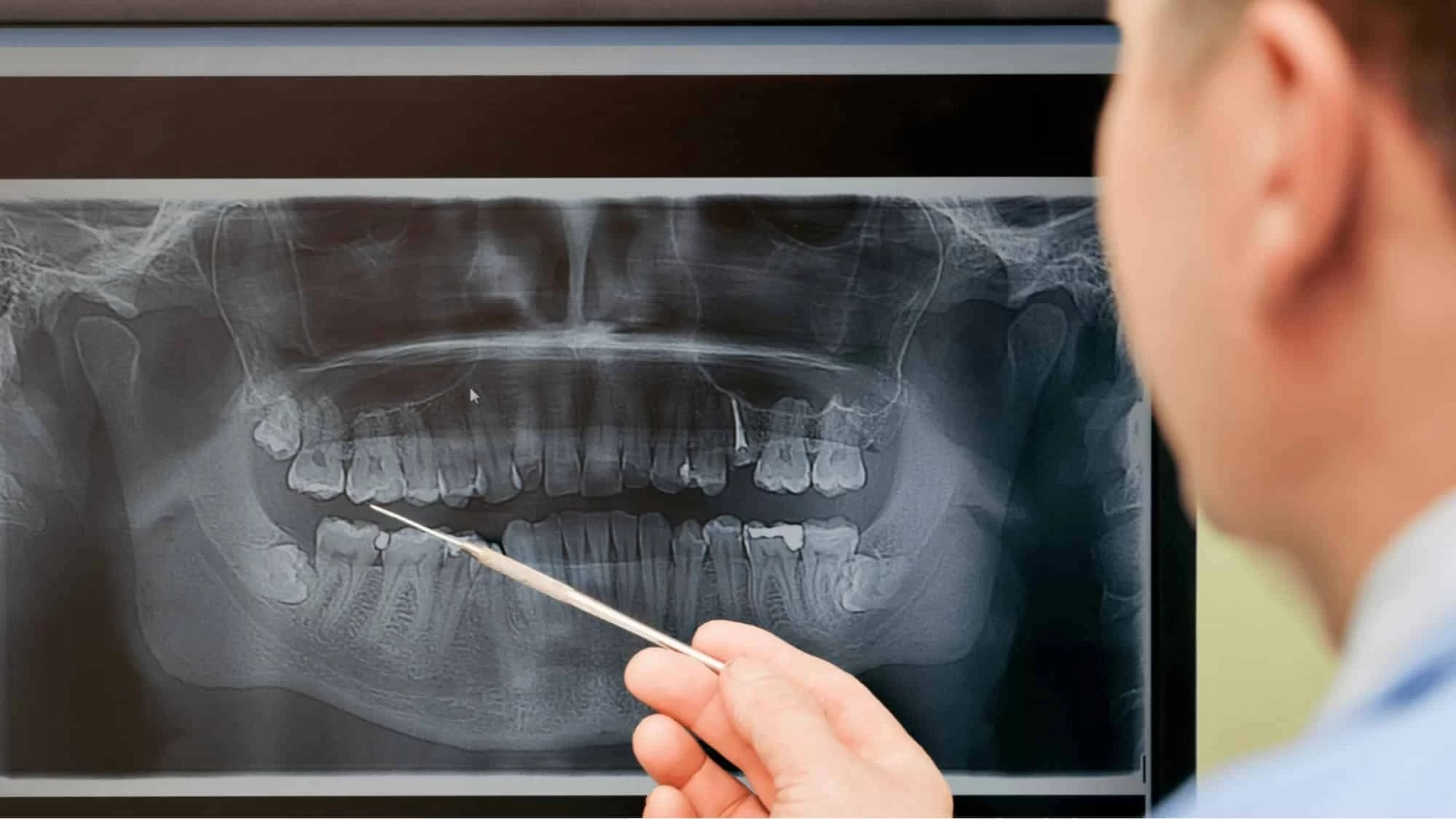 The Importance of Dental X-Rays and What They Detect – Essential for Early Diagnosis