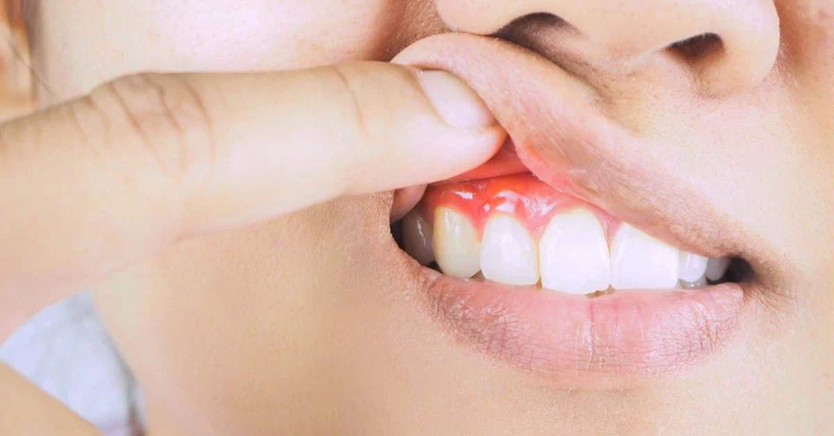 How to Know If You Have Gum Disease or Just Irritated Gums – Key Signs and Treatment Options