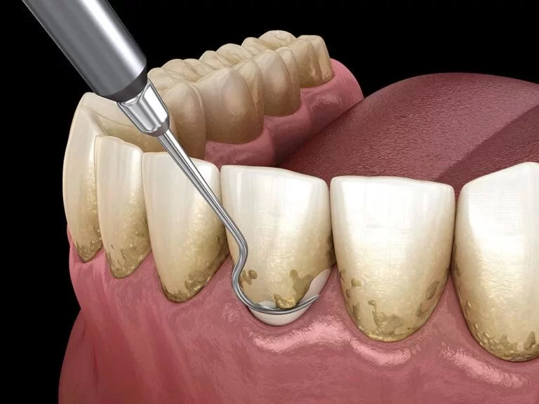 What is Dental Scaling and Root Planing? A Comprehensive Guide to Deep Cleaning and Gum Health