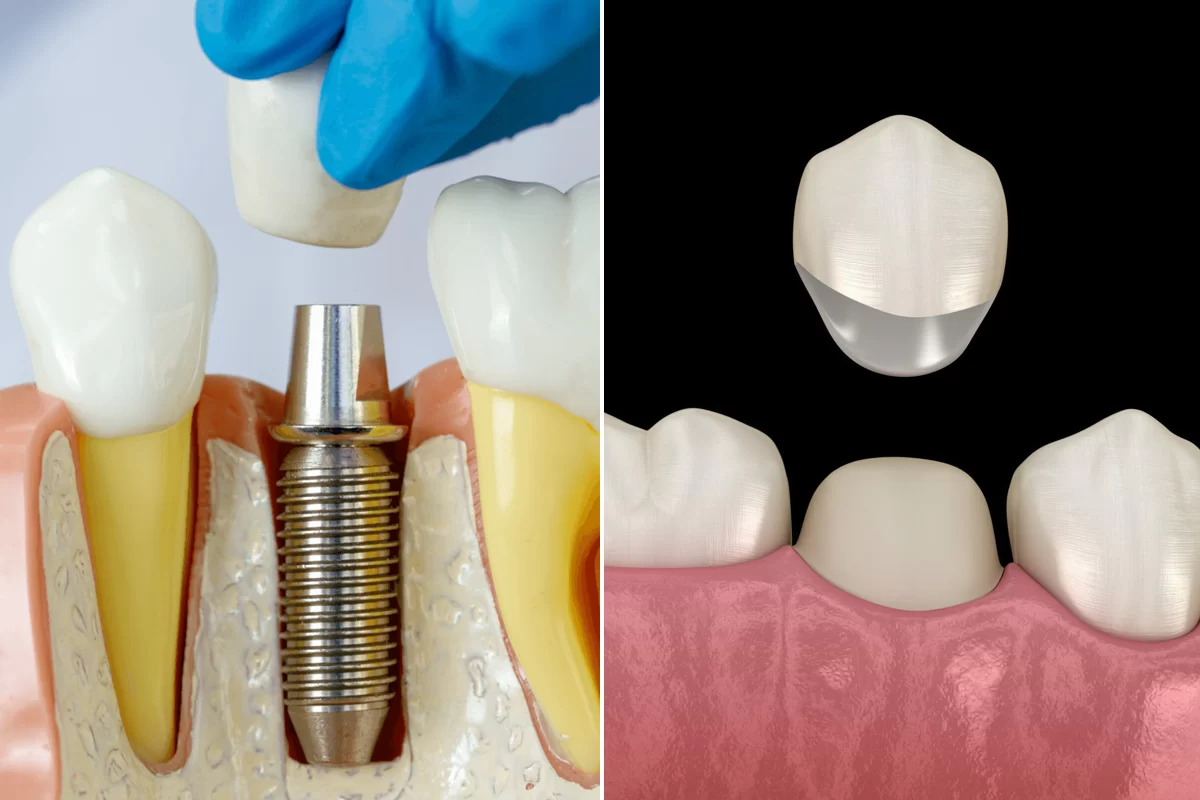Dental Implants vs Dental Crowns: Which is the Best Choice for You?