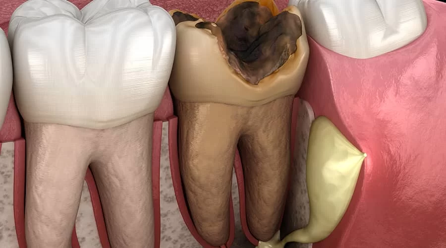 What Are the Signs of an Infected Tooth Root? Symptoms and What You Need to Know