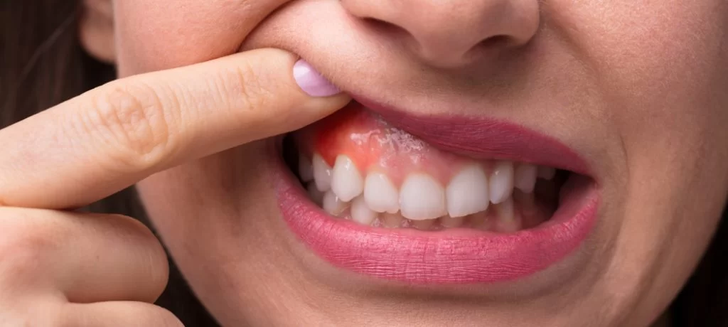 How to Treat Gum Disease with Natural Remedies: Effective Solutions for Healthier Gums
