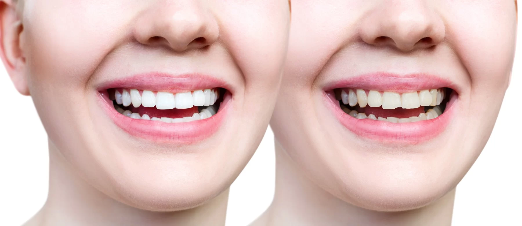 How to Prevent Teeth from Chipping or Cracking: Effective Tips for Stronger Teeth
