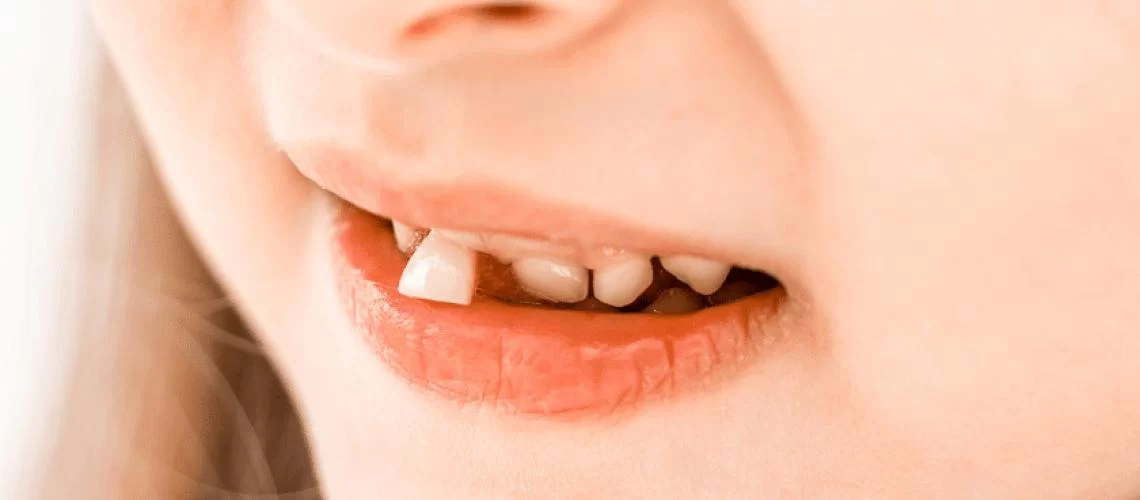 What to Do If Your Tooth Gets Knocked Out: A Step-by-Step Guide to Saving Your Tooth