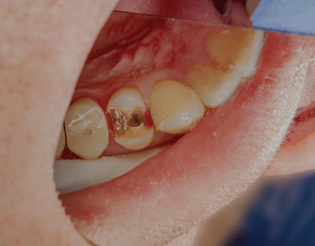 How to Stop a Cavity from Spreading: Effective Tips and Solutions