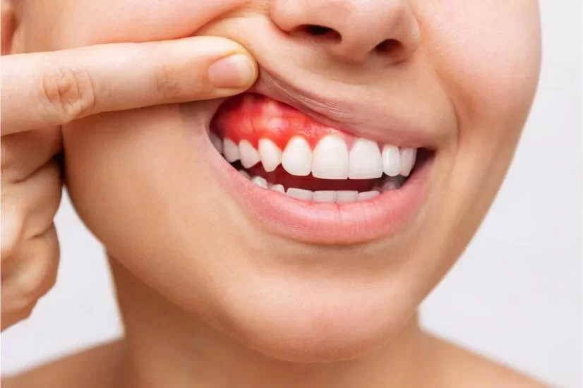 How to Treat Gingivitis at Home: Natural Remedies and Effective Treatments