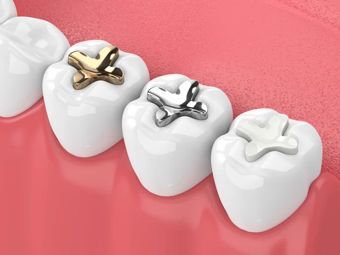 Why You Should Replace Old Fillings: Benefits and Important Reasons