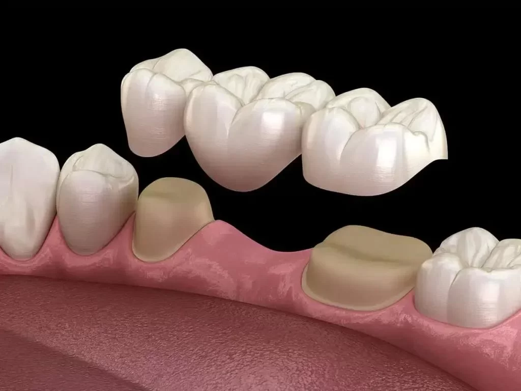 What is a Dental Bridge and When is it Needed? A Complete Guide to Dental Restoration