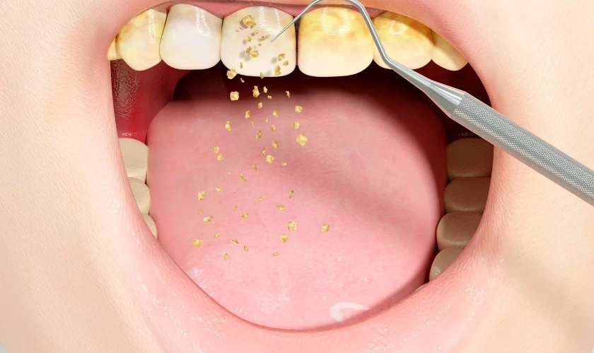 Signs You Need a Dental Cleaning After a Long Time