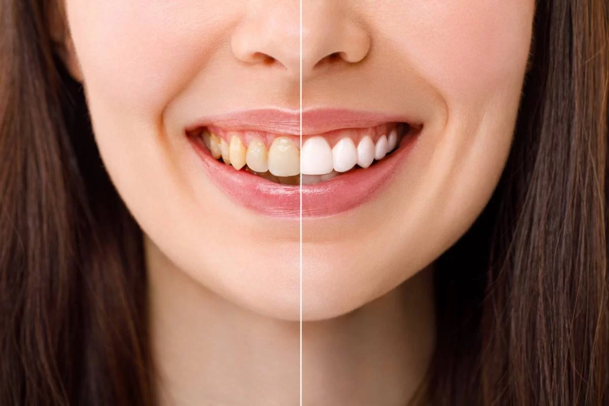 Can Teeth Whitening Cause Damage to Enamel?