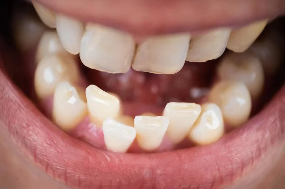 Can Dental Problems Affect Your Ability to Eat and Speak?