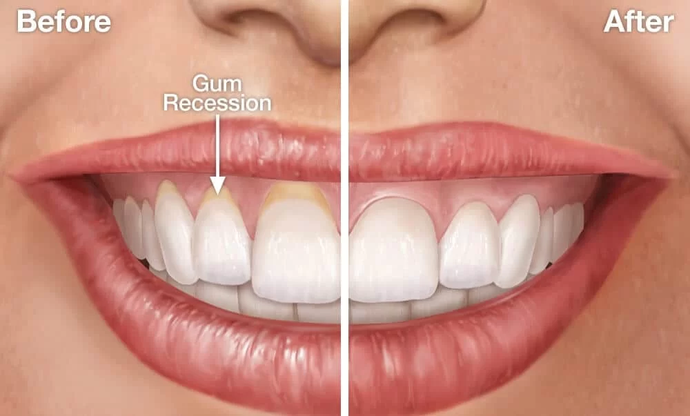 What is Gingival Recession and How to Fix It