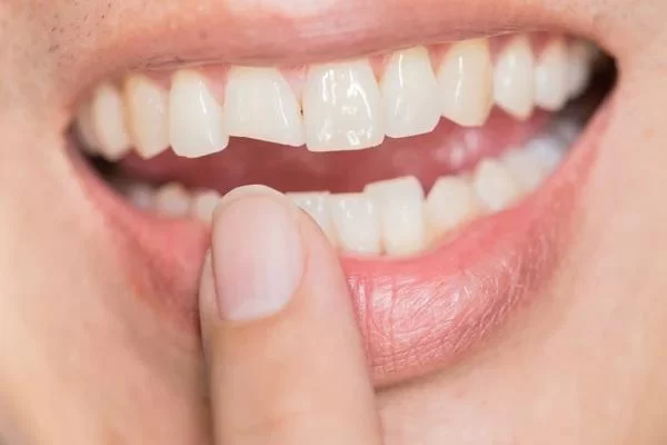 How to Fix a Chipped Tooth with Bonding: Effective Tooth Repair Options