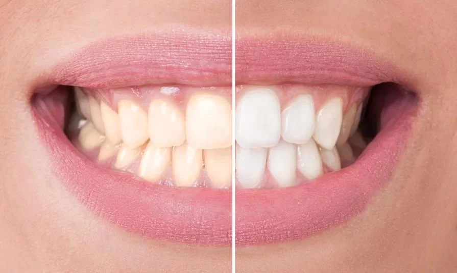 How to Avoid Staining Teeth from Tea: Effective Tips for Maintaining a Bright Smile