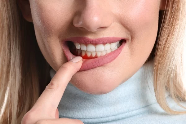 How to Treat Gingivitis at Home: Effective Natural Remedies for Healthy Gums