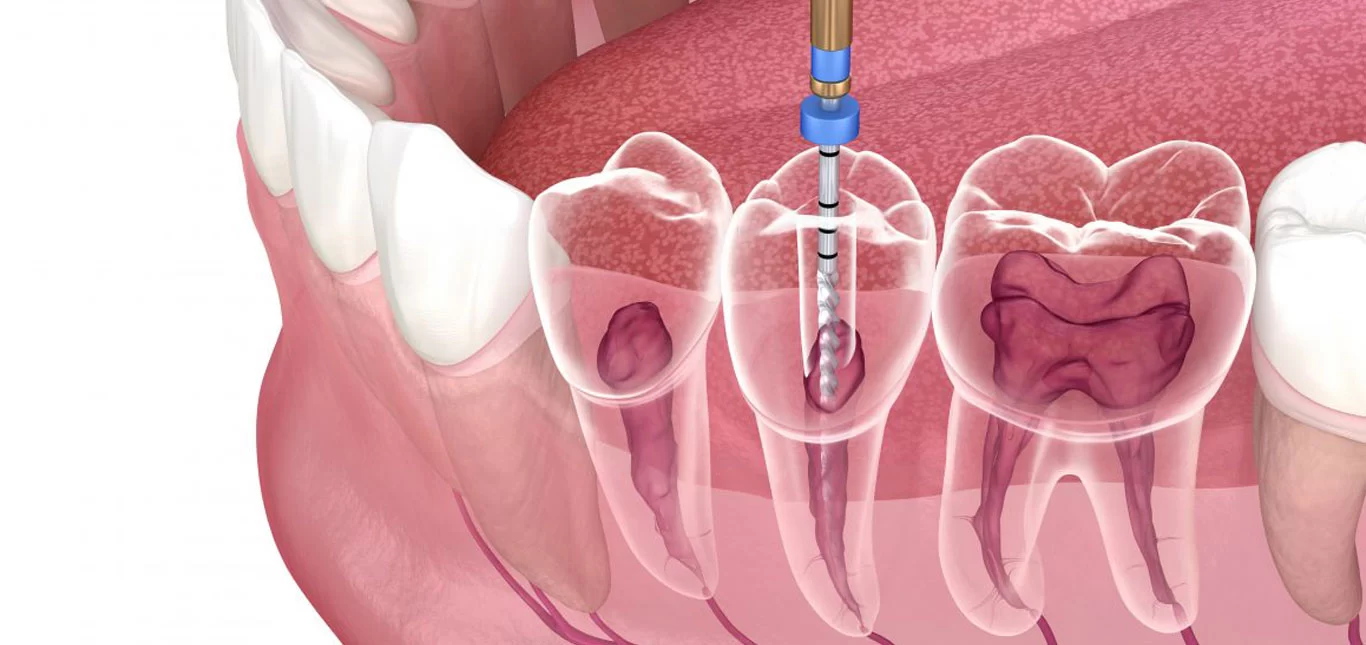 What to Expect During a Root Canal Procedure: Step-by-Step Guide to Root Canal Treatment