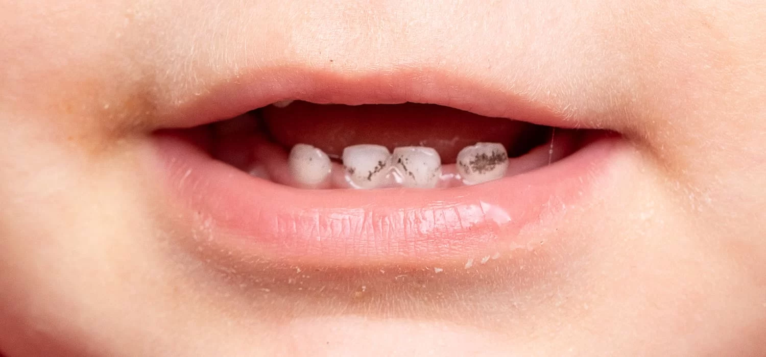 How to Treat a Cavity in a Baby Tooth: Effective Tips for Parents