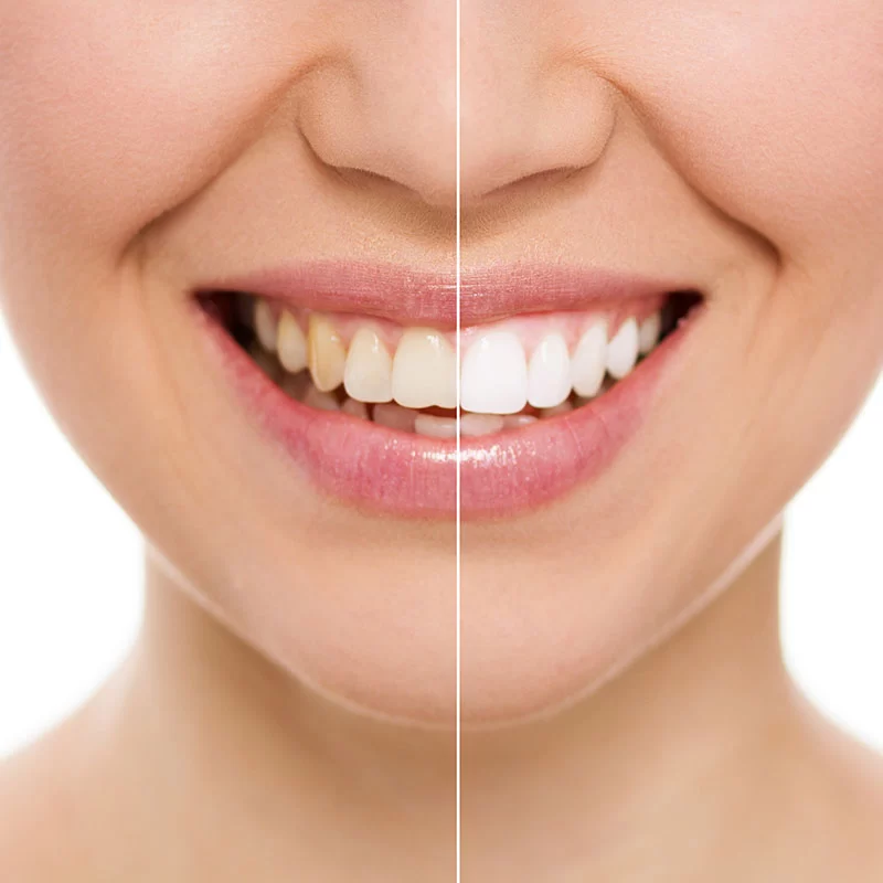 How to Remove Stains from Teeth Naturally: Effective Methods and Remedies