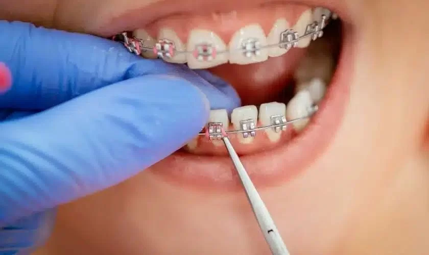 Oral Hygiene for Braces: Essential Tips for a Healthy Smile