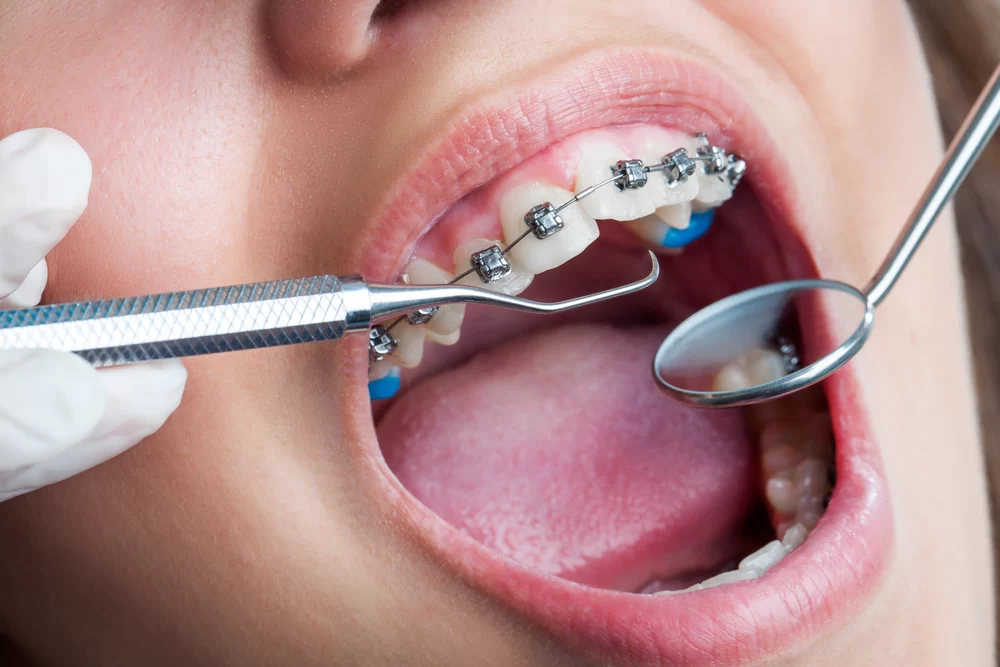 How to Fix an Overbite Without Surgery: Effective Non-Surgical Solutions