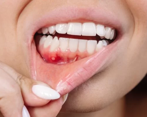 Gum Disease Management: How to Prevent and Treat Gum Disease Effectively