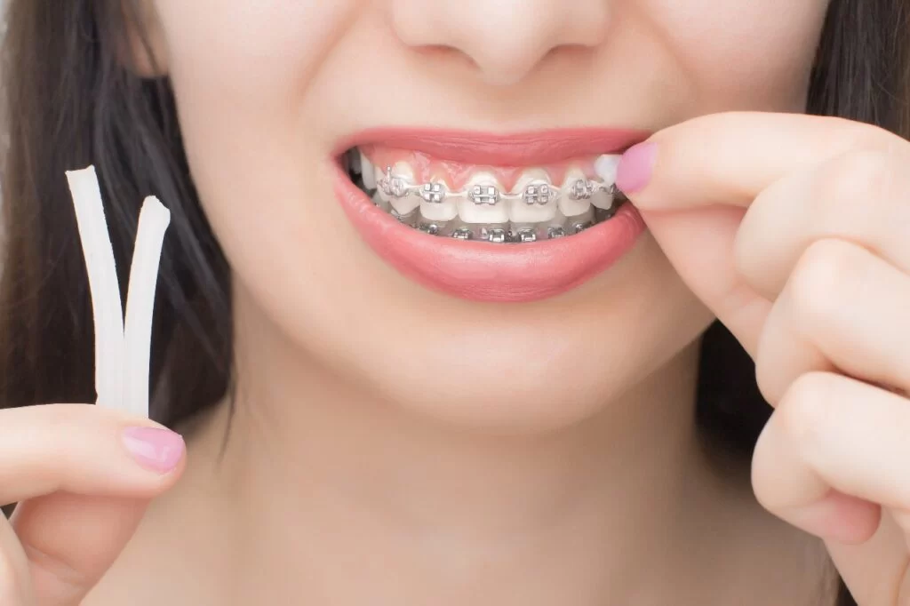 How to Use Dental Wax for Braces - A Complete Guide