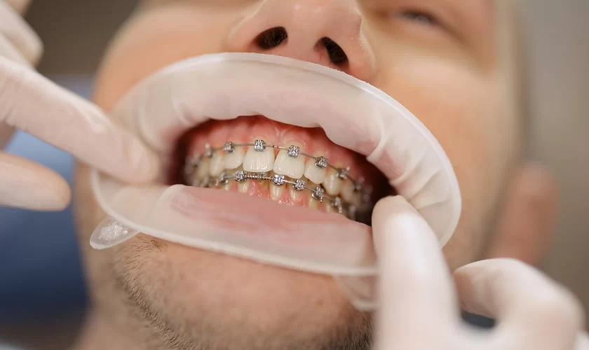 Orthodontic Care Tips for a Beautiful Smile During Treatment