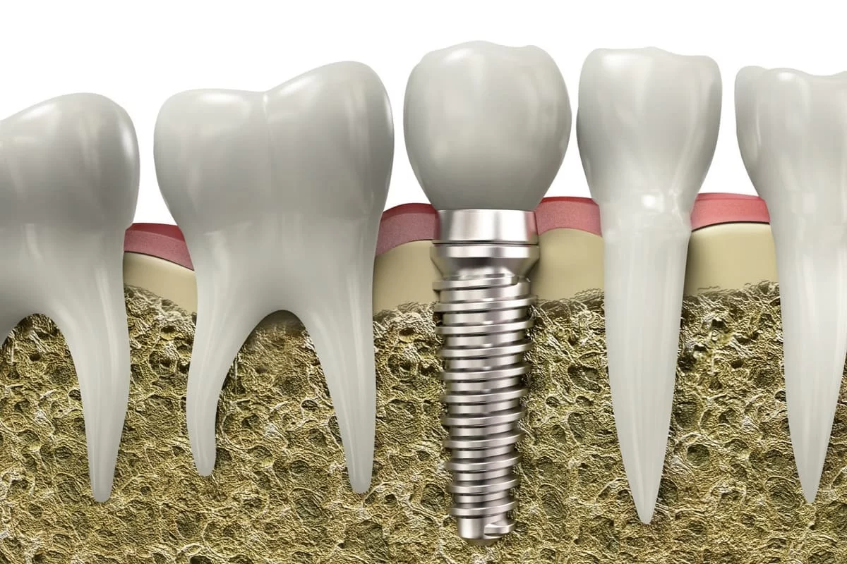 Best Practices for Maintaining Your Dental Implants: Essential Tips for Longevity
