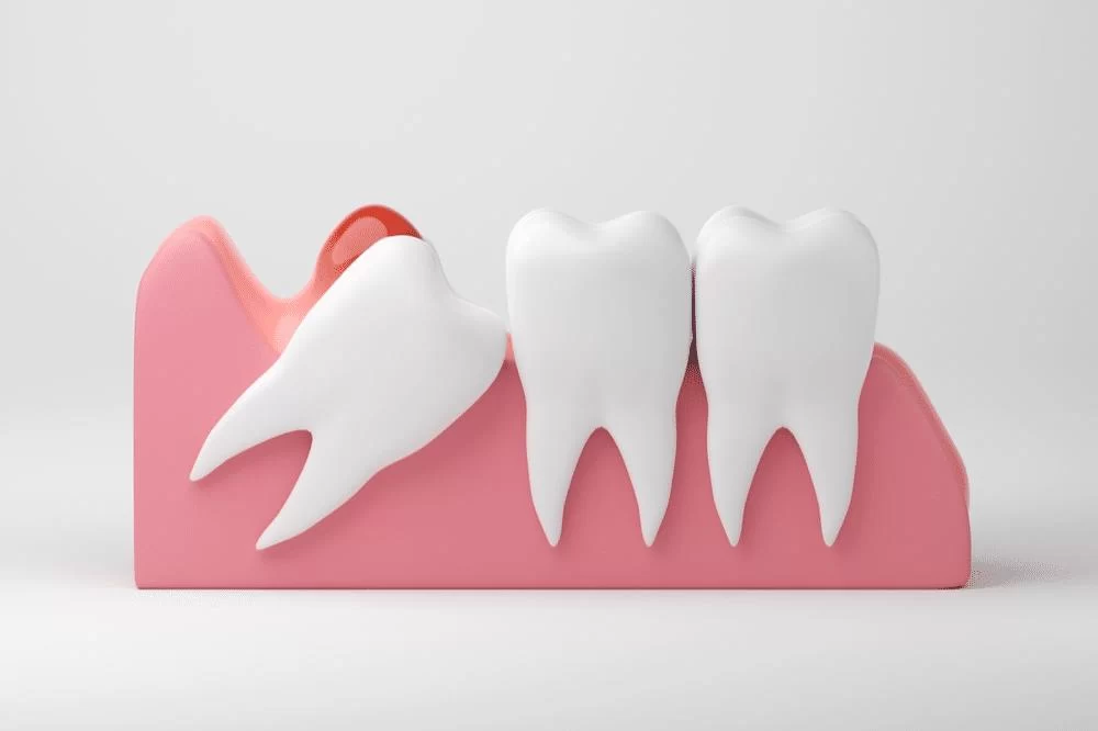 How to Treat an Infected Wisdom Tooth: Essential Steps and Tips for Relief