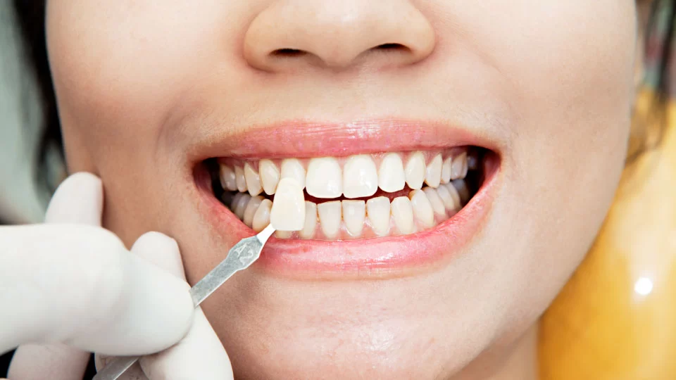 How Long Do Veneers Last on Teeth? Discover the Lifespan of Porcelain Veneers
