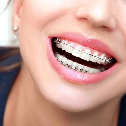How Much Do Braces Cost for Adults? Understanding the Price and Options