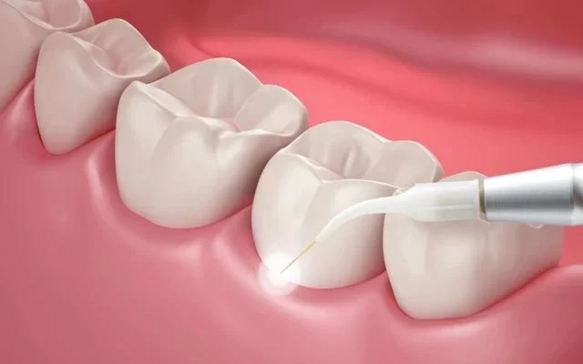 Laser Treatment for Gum Disease: A Revolutionary Solution for Gum Health