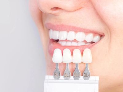 Advantages of Porcelain Dental Restorations