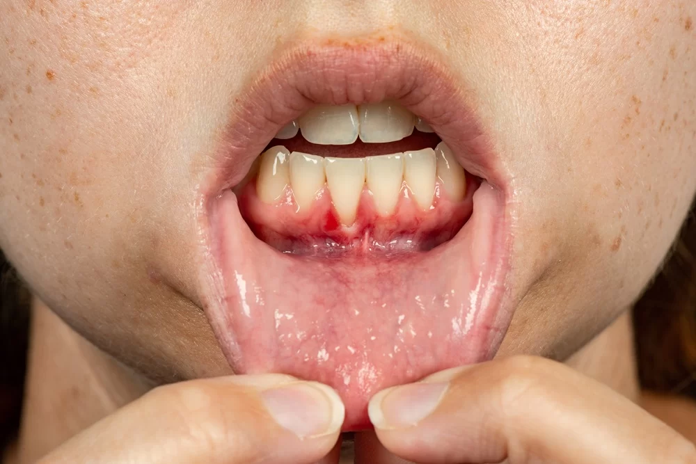 Symptoms of a Gum Infection and Treatment: How to Identify and Treat Gum Infections