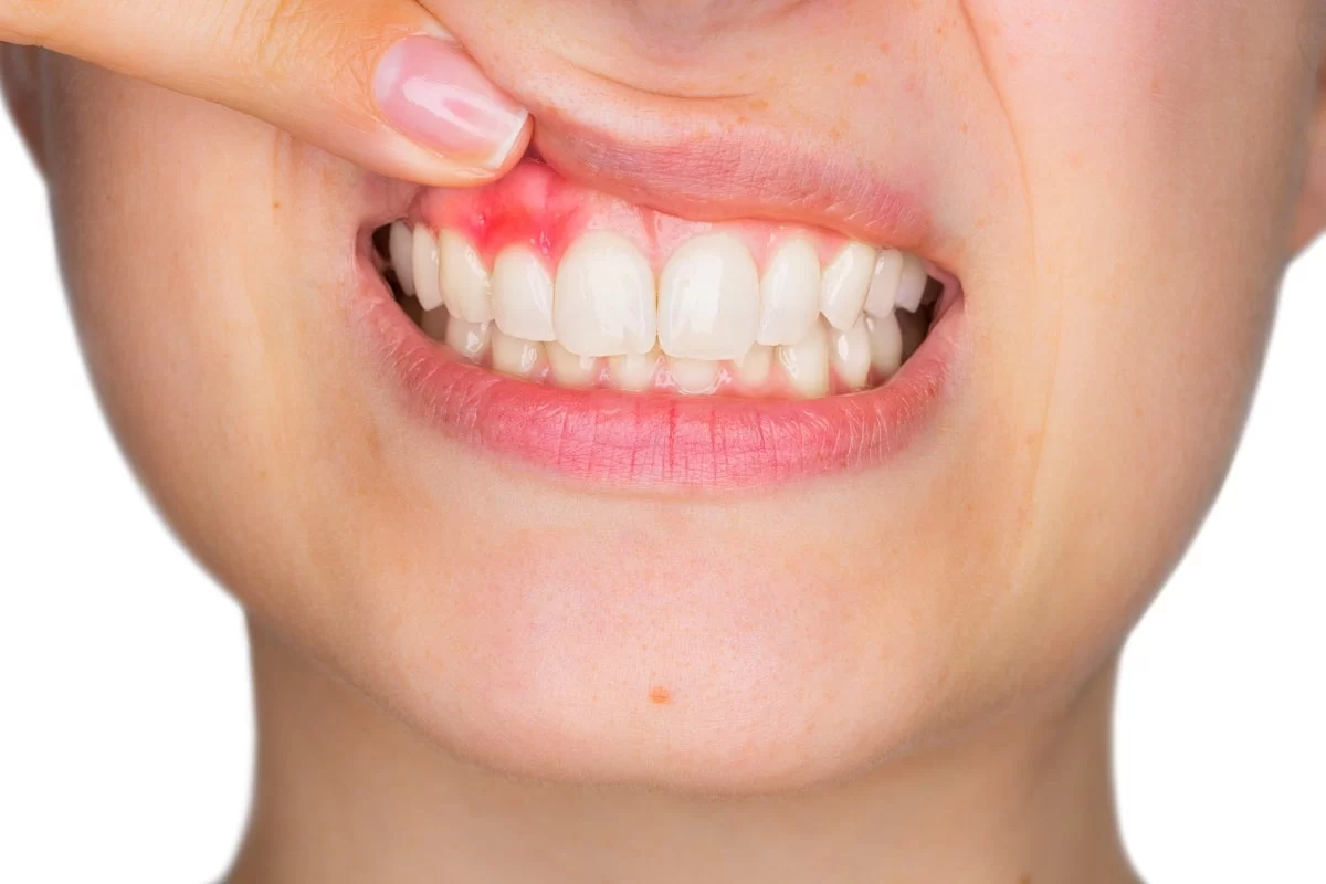 Symptoms of Gum Recession and How to Treat It: Expert Advice and Tips