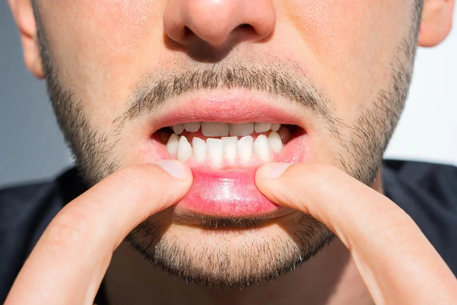 How to Prevent Tooth Loss Due to Gum Disease