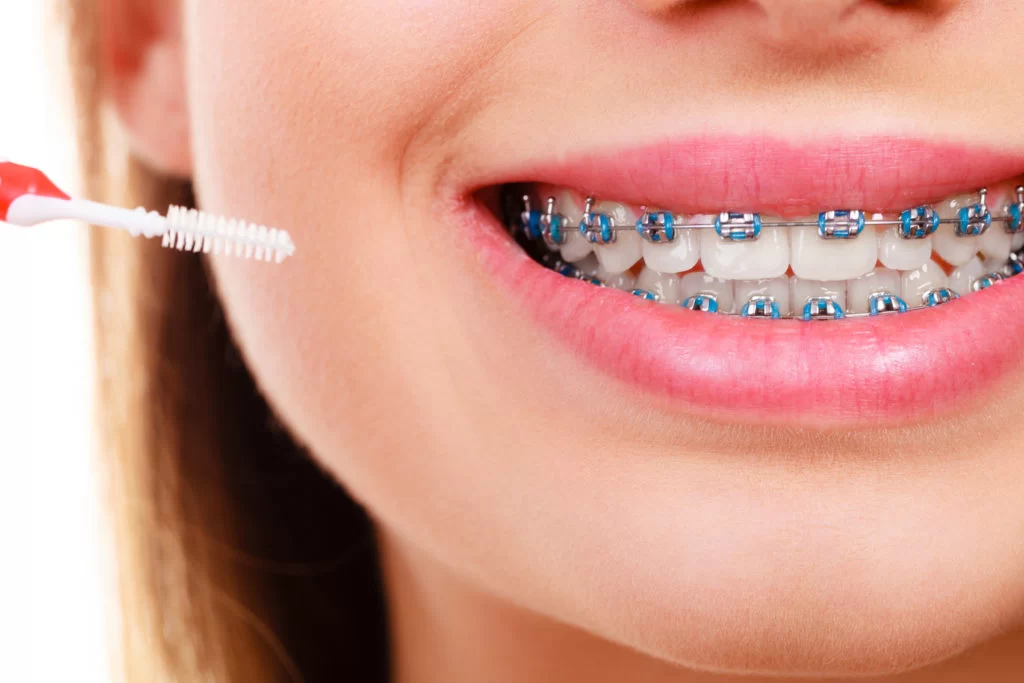 Best Way to Clean Teeth with Braces: Essential Tips for Effective Braces Oral Care
