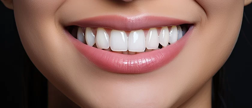 Can You Whiten Teeth with Veneers? Explore How Veneers Enhance Your Smile