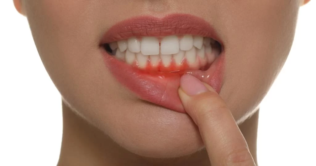 How to Avoid Gum Disease While Wearing Dentures