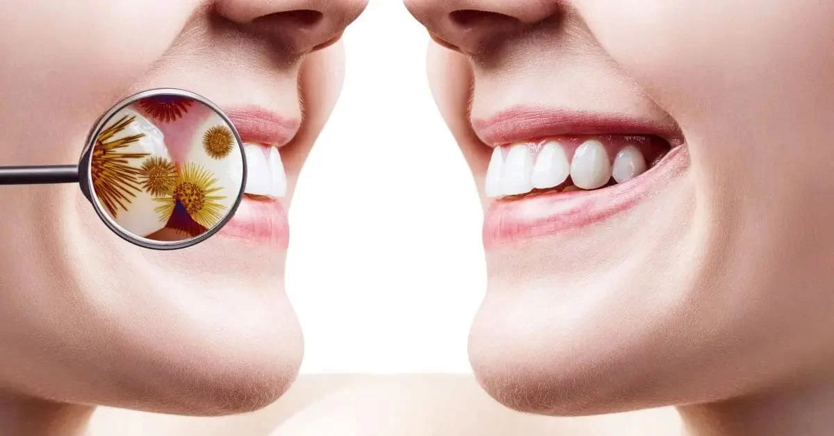 Can an Untreated Tooth Infection Spread to Your Brain? Understanding the Risks and Complications