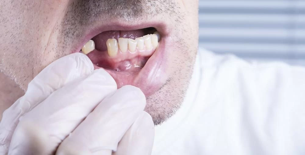What to Do If You Lose a Tooth? Essential Steps to Take Immediately