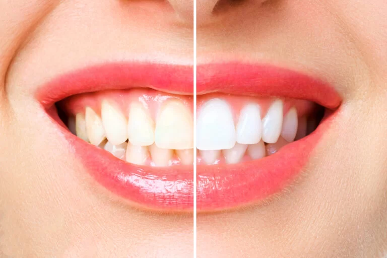 What to Expect After Teeth Whitening - Care & Maintenance Tips