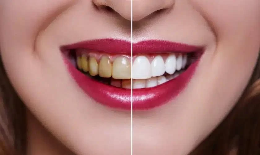 What is the Best Way to Whiten Your Teeth Professionally?