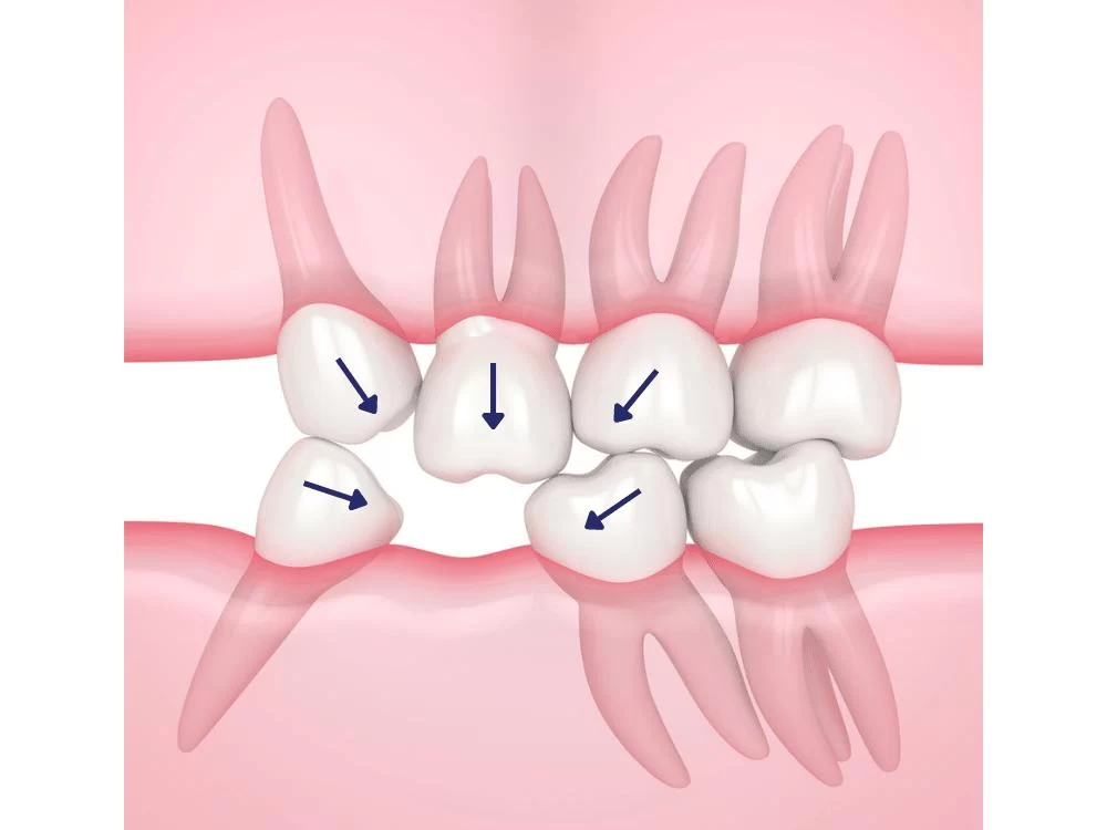 Dental Implant Alternatives for Missing Teeth: The Best Tooth Replacement Solutions