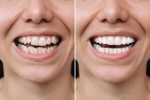 Can I Get Veneers for Crooked Teeth? Everything You Need to Know
