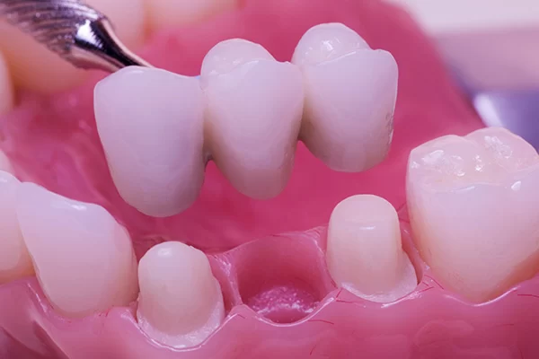 Dental Implants vs Bridges for Missing Teeth: Which is Right for You?