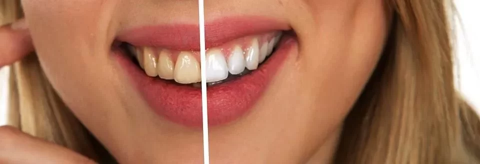 How to Fix Yellow Teeth Without Whitening: Natural Ways to Improve Your Smile